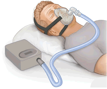 Picture of person using CPAP breathing system.